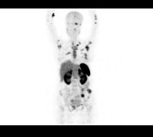 Read more about the article PRIMARY HYPERPARATHYROIDISM – 68Ga-DOTANOC IMAGING  A CASE REPORT