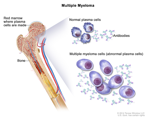 Read more about the article WHAT IS MULTIPLE MYELOMA?