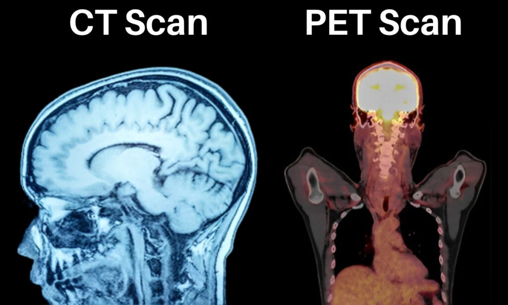 Choosing your Diagnosis: PET Scan VS CT Scan