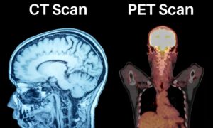 Read more about the article Choosing your Diagnosis: PET Scan VS CT Scan