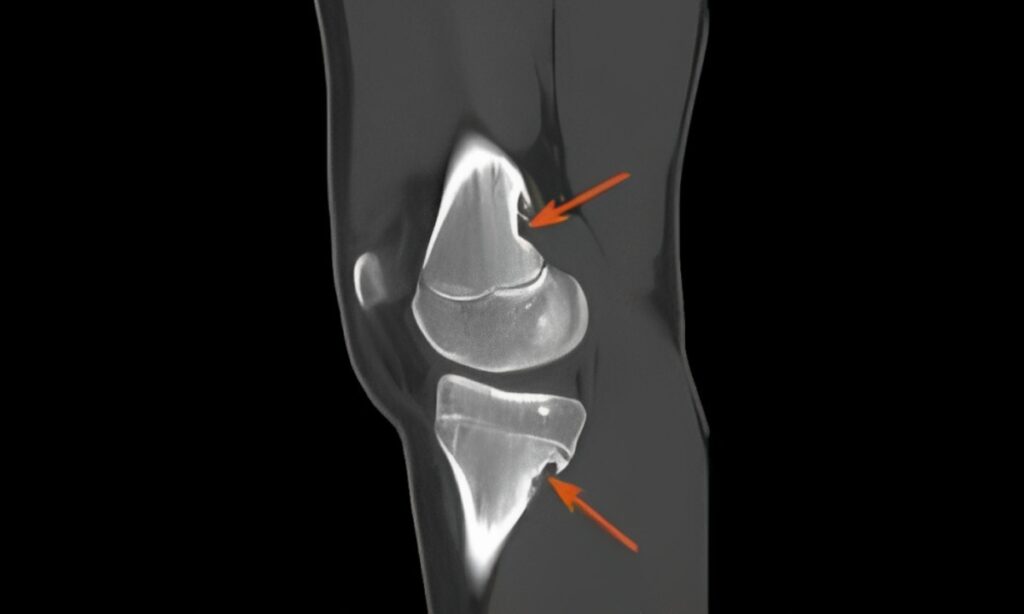 CT Scans for Knee Injuries