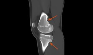 Read more about the article CT Scans for Knee Injuries