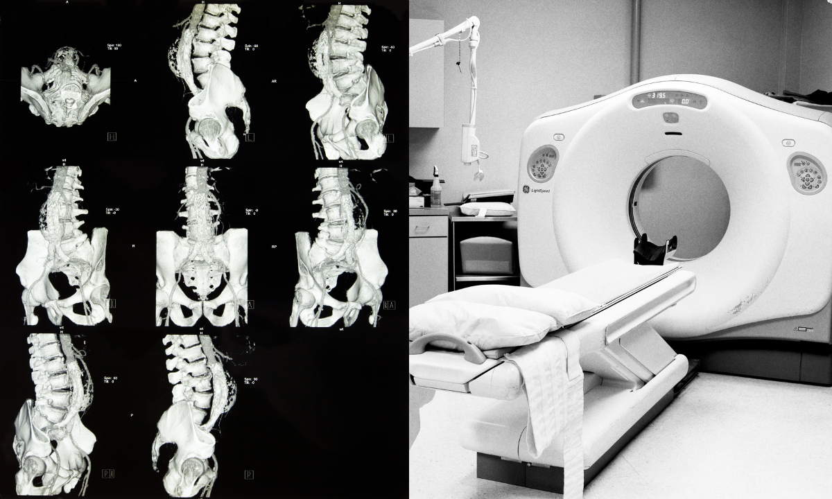 CT Scan for Abdomen and Pelvis