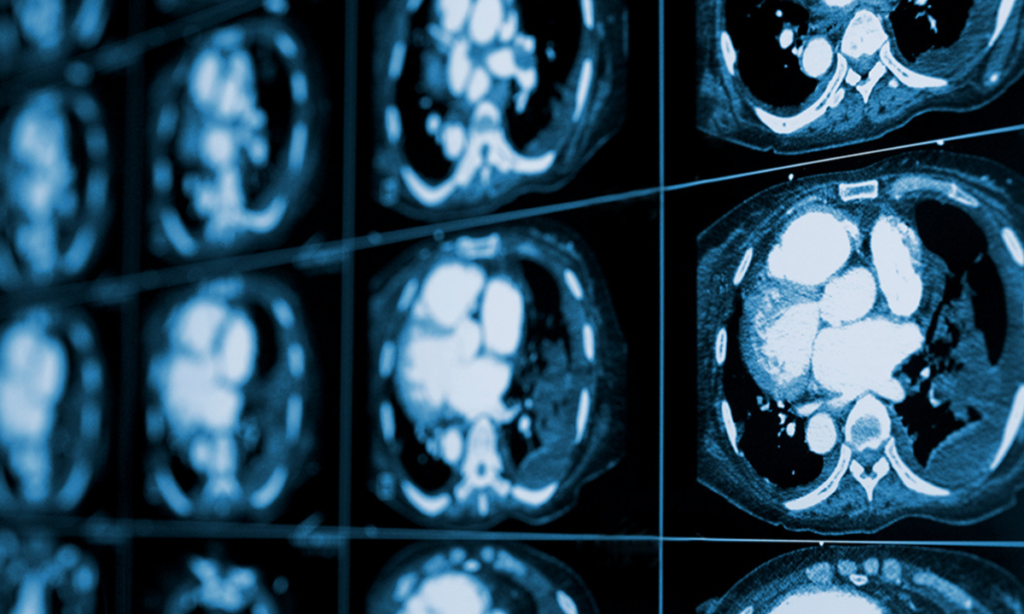 CT Scans for Heart Health