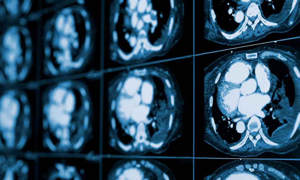 Risks-and-Limitations-of-CT-Scans-for-Heart-Health - Kiran Lab