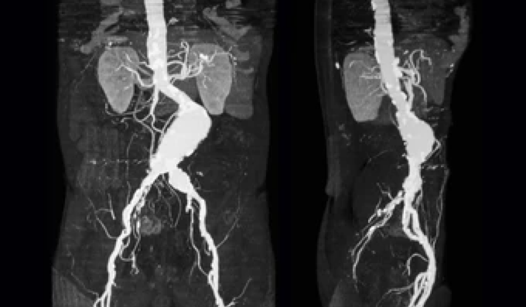 What is a CT aortogram and how does it work?