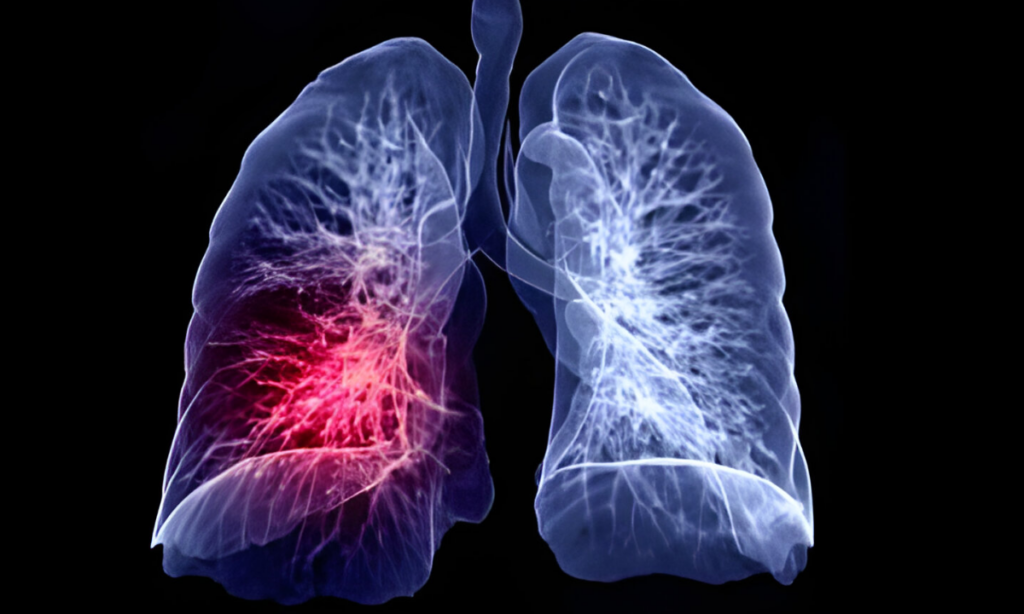 Lung Cancer PET CT scan