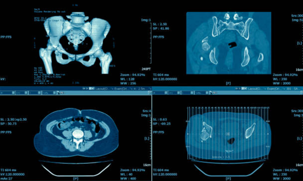 Why Use CT Scans for Pelvic Imaging?