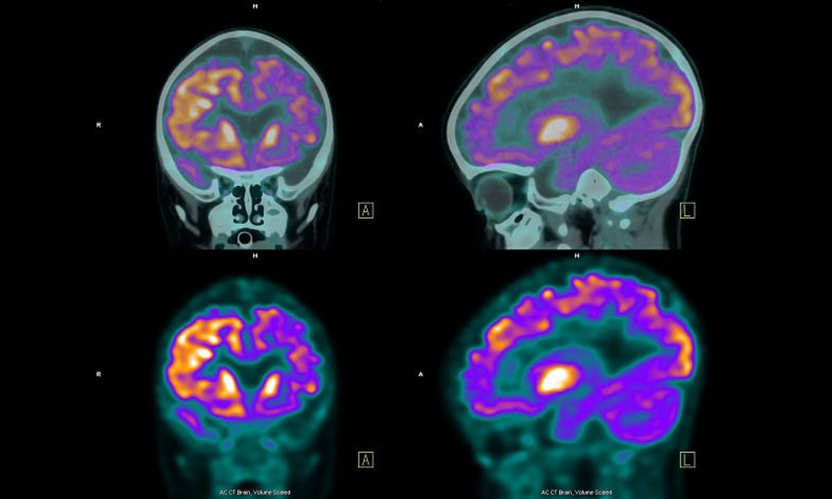 pet ct scan in bangalore