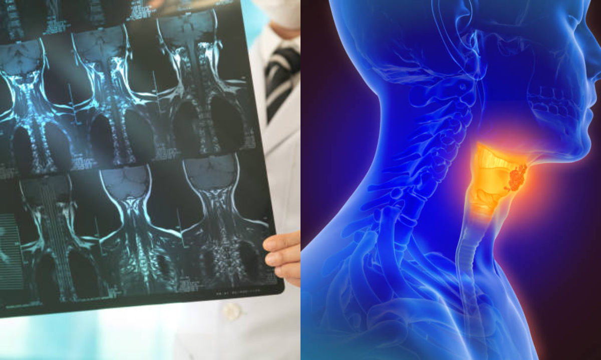 FAPI PET CT in Head and Neck Cancers