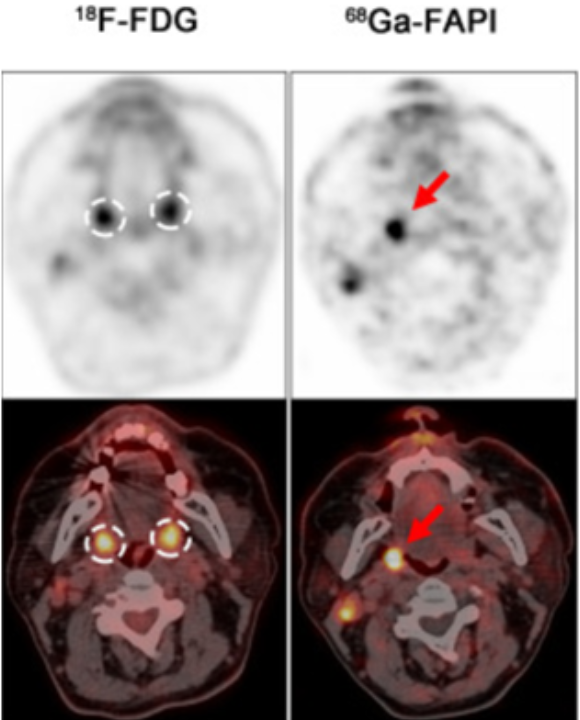 fapi pet ct scan