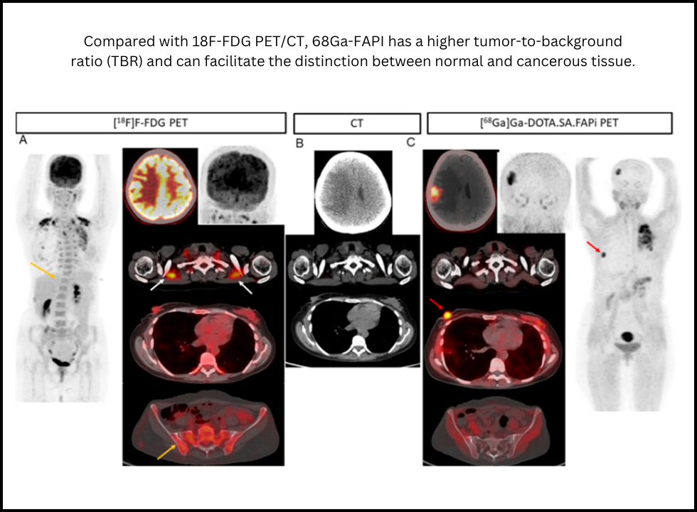 fapi pet ct for breast cancer