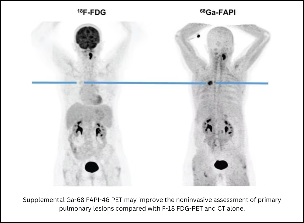 fdg pet ct scan