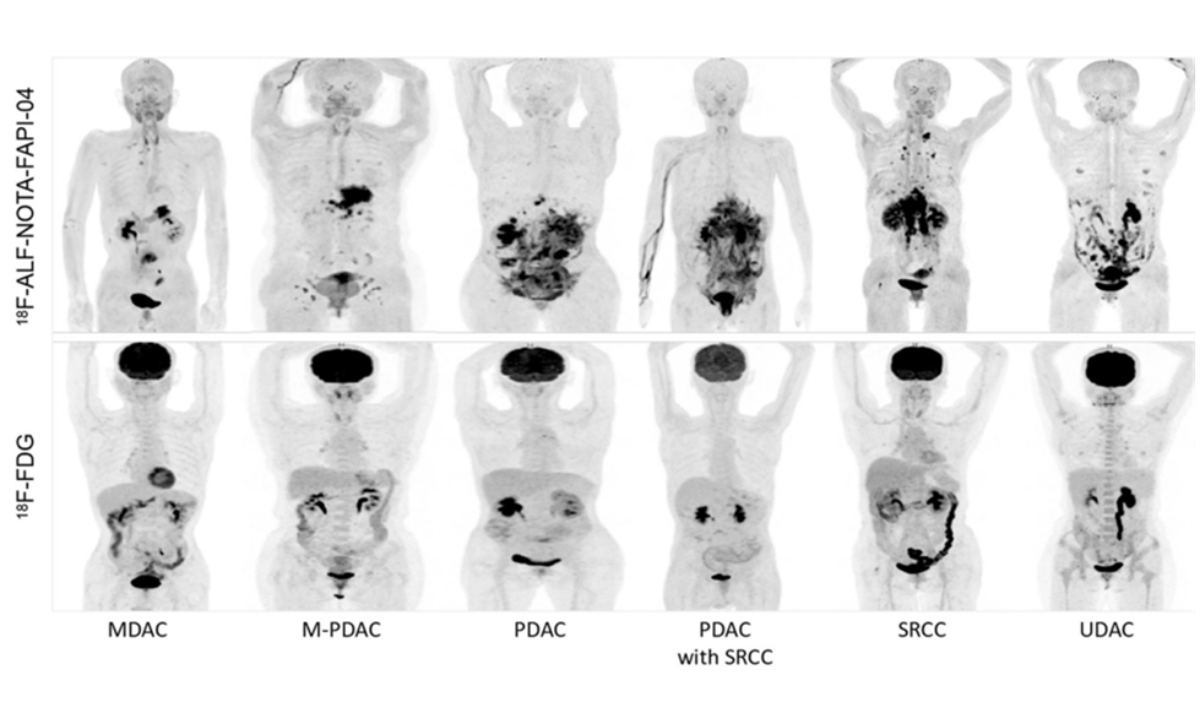 fdg pet ct scan