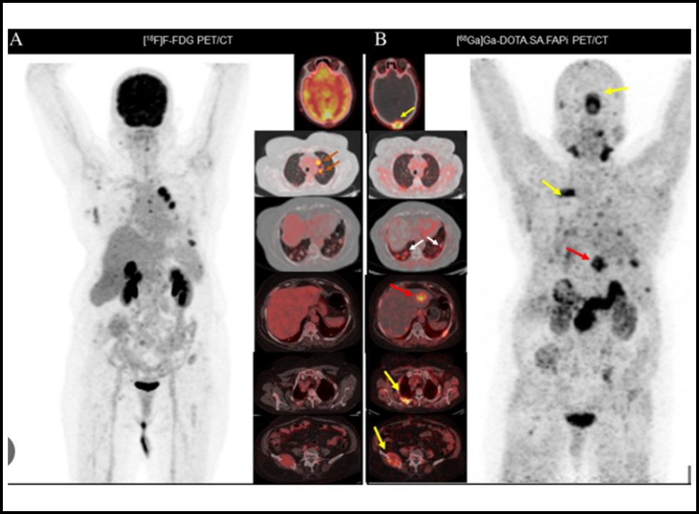 fapi pet ct scan