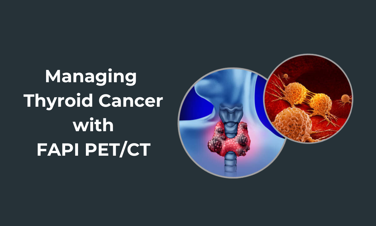 fapi pet ct scan in managing thyroid cancer