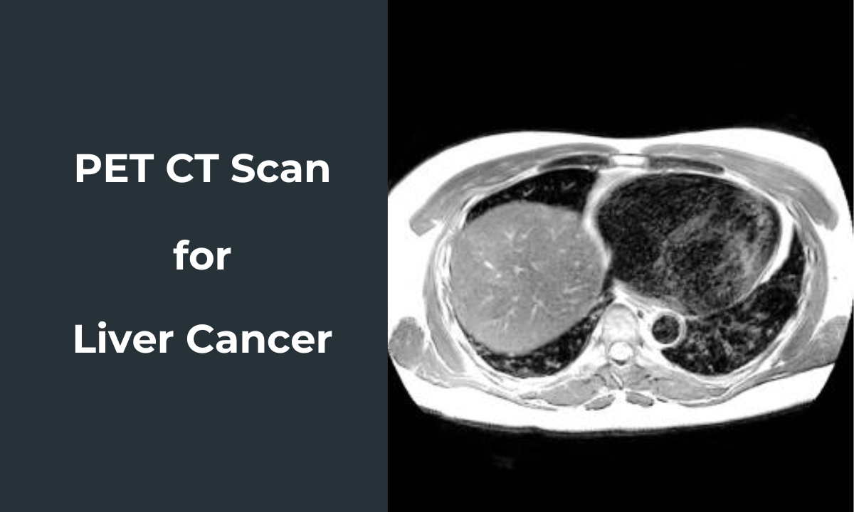 pet ct scan for liver cancer detection