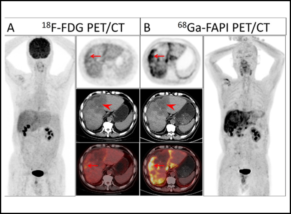 fapi pet ct scan