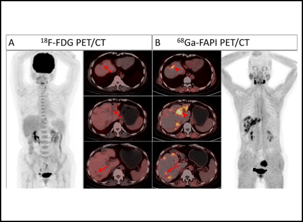 fdg pet ct scan