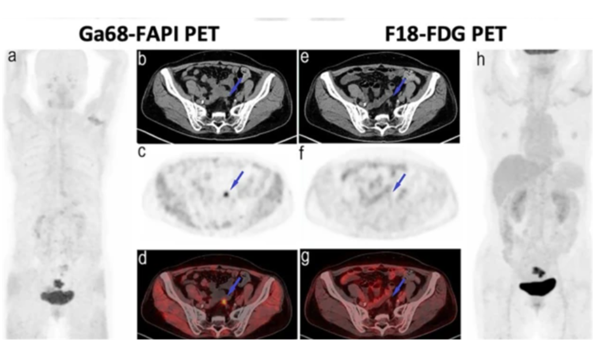 PET scan