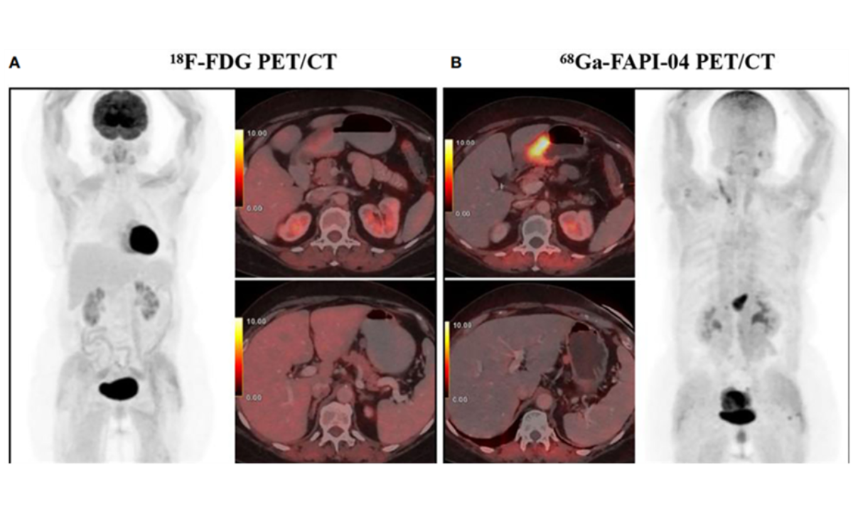 fapi pet scan