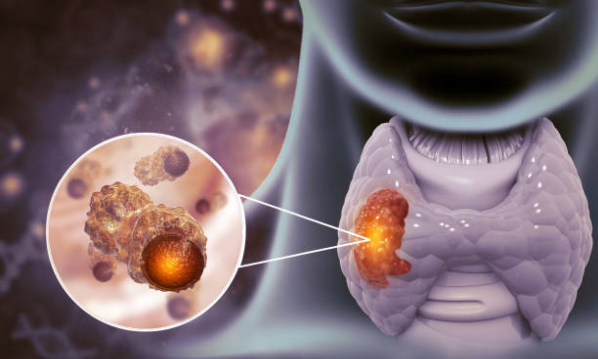 Thyroid gland CT scan in Bangalore