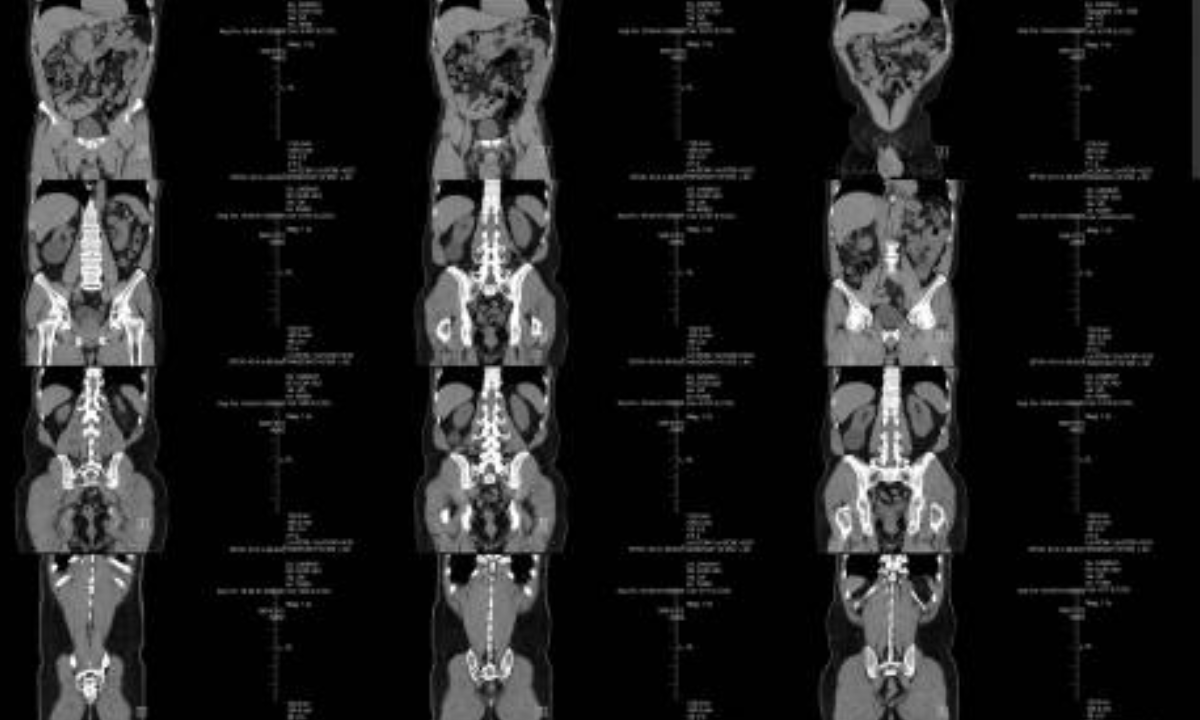 PET scan in Bangalore