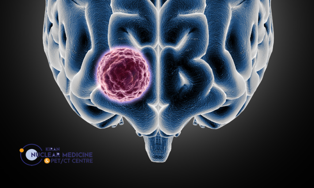 How Lutetium Therapy Helps Treat Neuroendocrine Tumors
