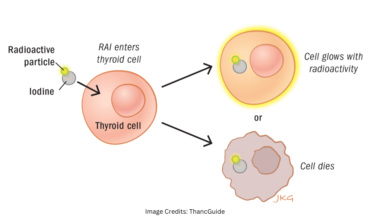 Understanding Radioactive Iodine Uptake