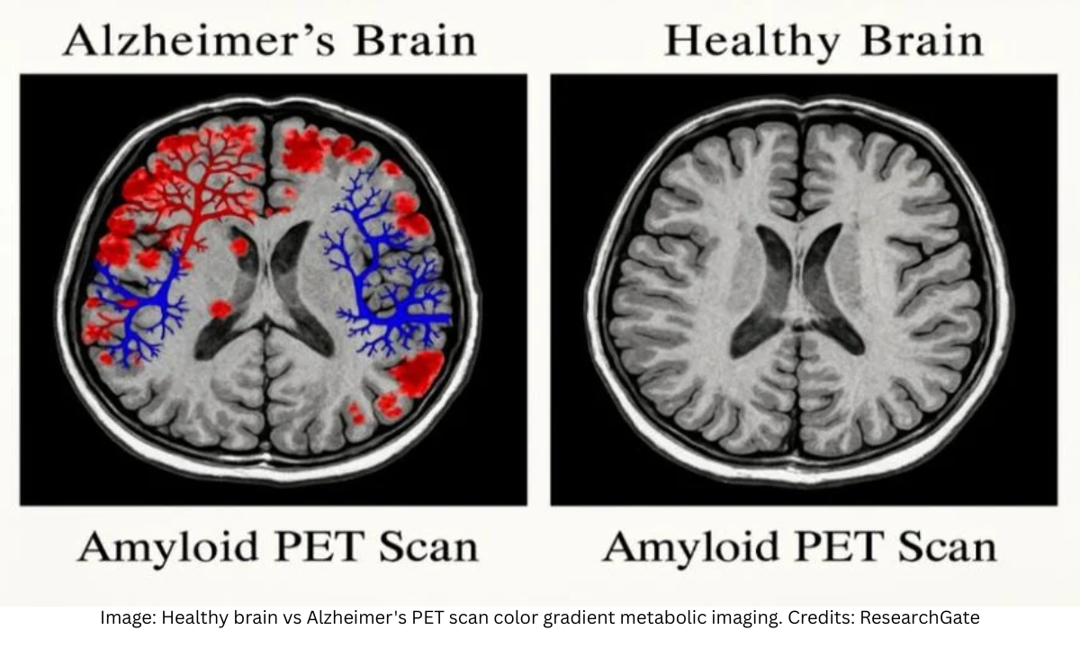 PET Imaging: Alzheimer’s Comparison