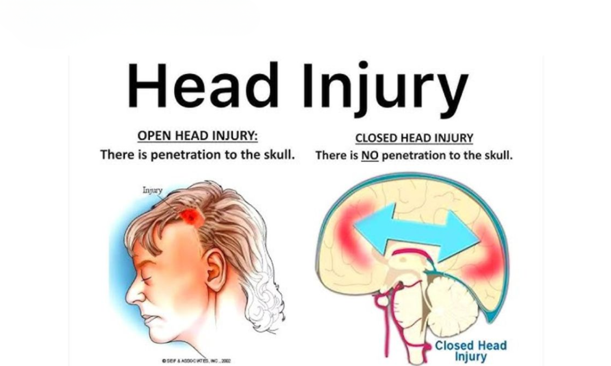 What is head injury?