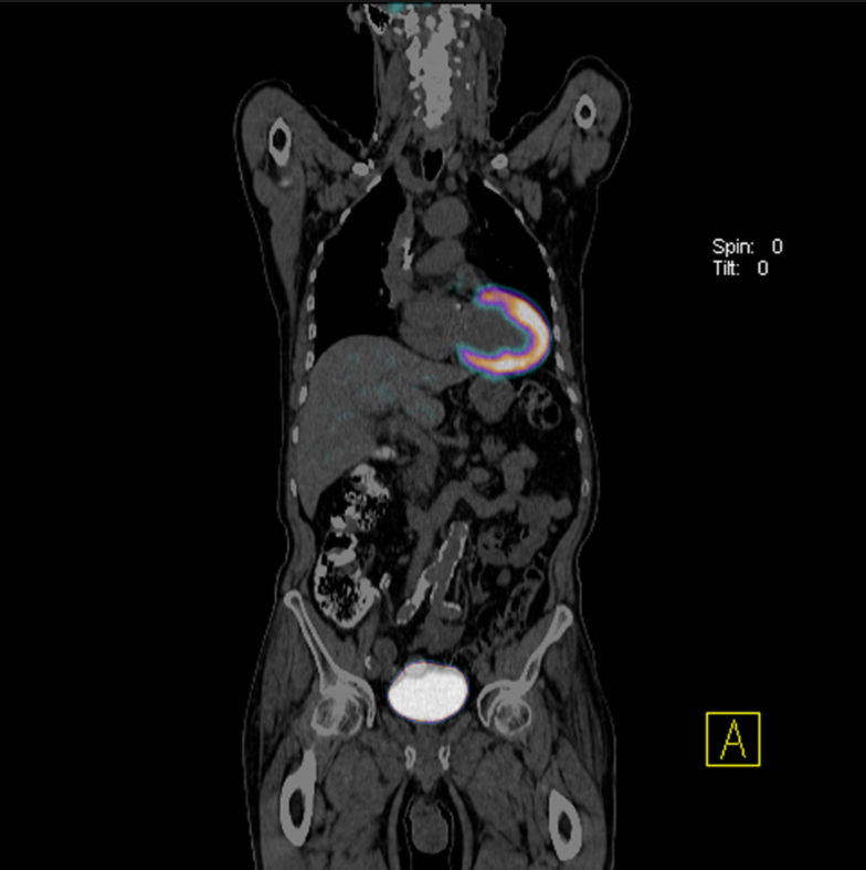 an x ray of coronary artery image 