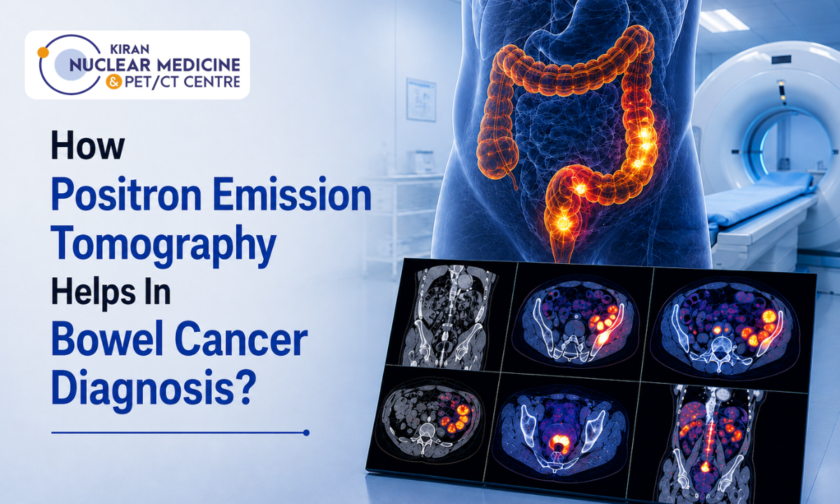 PET-CT showing bowel cancer activity