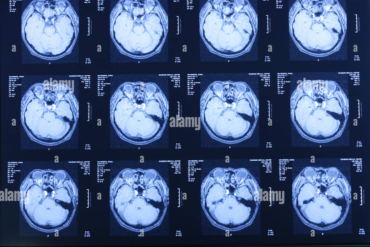 CT scan image showing brain bleeding and swelling after head injury
